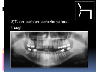 8)Teeth position posterior to focal
trough
 