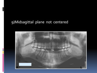 9)Midsagittal plane not centered
R L
 