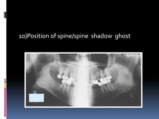 10)Position of spine/spine shadow ghost
 