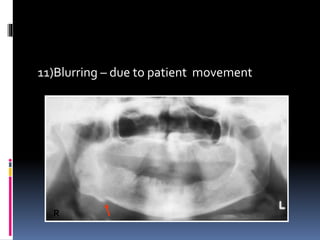 11)Blurring – due to patient movement
R
 
