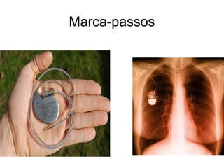 Marca-passos
 