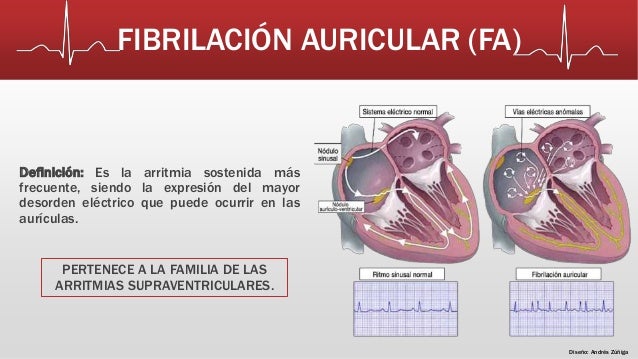 Fibrilación Auricular