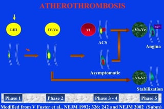 I-III IV-Va
Asymptomatic
Modified from V Fuster et al., NEJM 1992; 326: 242 and NEJM 2002 (Subm)
VI
Angina
Vb-Vc
Ca++
Phase 3 - 4Phase 1 Phase 2 Phase 5
Stabilization
Vb-Vc
ATHEROTHROMBOSIS
ACS
 