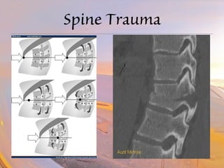 Spine Trauma 
 