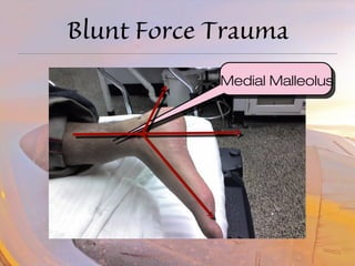 Blunt Force Trauma 
Medial Malleolus 
 