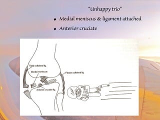“Unhappy trio” 
• Medial meniscus & ligament attached 
• Anterior cruciate 
 