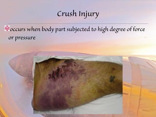 Crush Injury 
occurs when body part subjected to high degree of force 
or pressure 
 