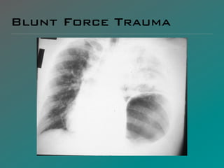 Blunt Force Trauma
 