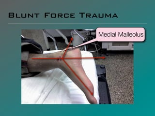 Blunt Force Trauma
              Medial Malleolus
 