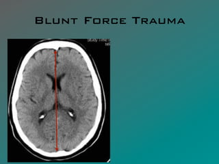 Blunt Force Trauma
 