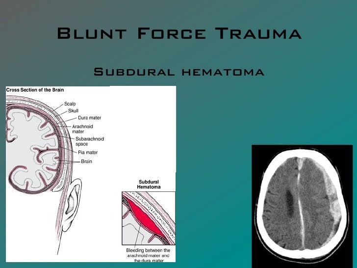 FCA 0111 Blunt Force Trauma