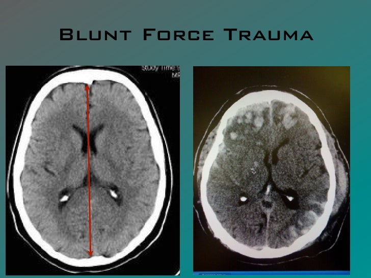 FCA 0111 Blunt Force Trauma