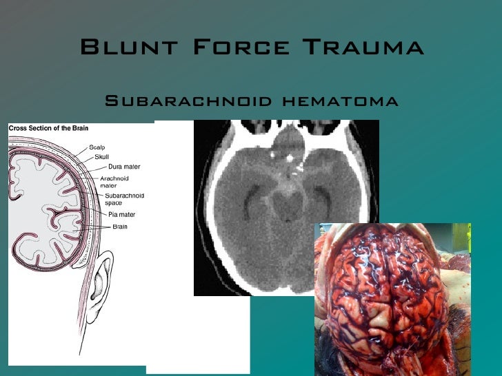 FCA 0111 Blunt Force Trauma