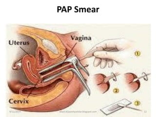PAP Smear9/12/201412www.drjayeshpatidar.blogspot.com
