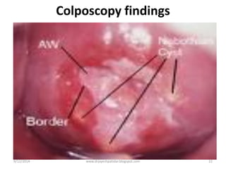 Colposcopy findings
9/12/2014
22www.drjayeshpatidar.blogspot.com