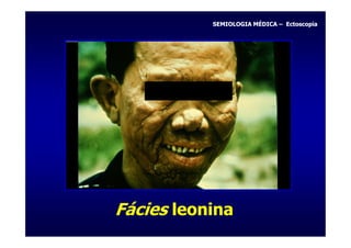 SEMIOLOGIA MÉDICA – Ectoscopia




Fácies leonina
 
