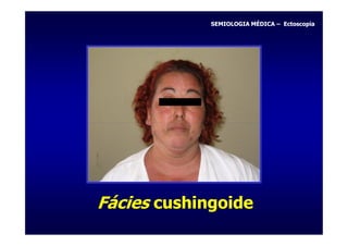 SEMIOLOGIA MÉDICA – Ectoscopia




Fácies cushingoide
 