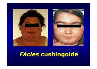 Fácies cushingoide
 