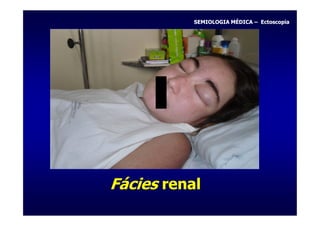 SEMIOLOGIA MÉDICA – Ectoscopia




Fácies renal
 