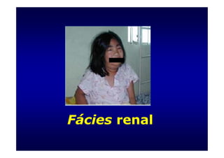Fácies renal
 