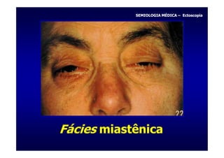 SEMIOLOGIA MÉDICA – Ectoscopia




Fácies miastênica
 