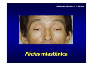 SEMIOLOGIA MÉDICA – Ectoscopia




Fácies miastênica
 