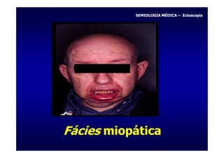 SEMIOLOGIA MÉDICA – Ectoscopia




Fácies miopática
 