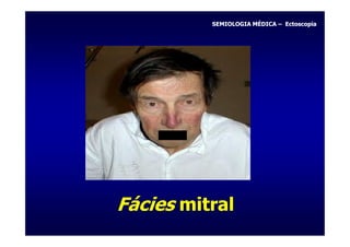 SEMIOLOGIA MÉDICA – Ectoscopia




Fácies mitral
 