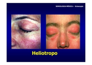 SEMIOLOGIA MÉDICA – Ectoscopia




Heliotropo
 