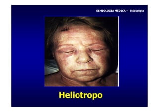 SEMIOLOGIA MÉDICA – Ectoscopia




Heliotropo
 