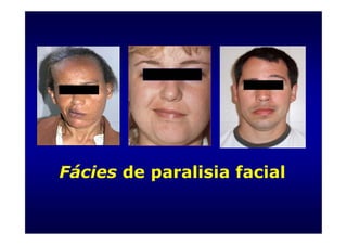 Fácies de paralisia facial
 