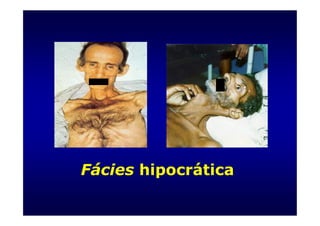Fácies hipocrática
 