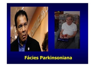 Fácies Parkinsoniana
 