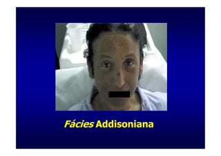 Fácies Addisoniana
 