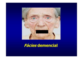 Fácies demencial
 