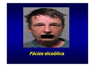 Fácies alcoólica
 
