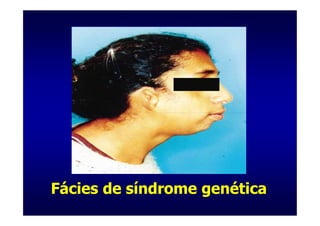 Fácies de síndrome genética
 