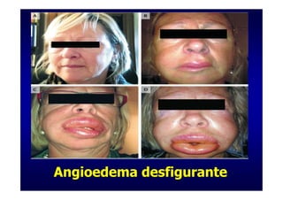 Angioedema desfigurante
 