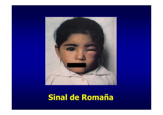Sinal de Romaña
 