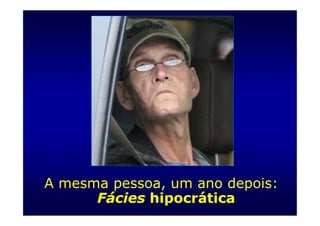 A mesma pessoa, um ano depois:
      Fácies hipocrática
 