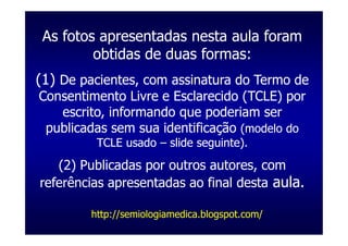 As fotos apresentadas nesta aula foram
         obtidas de duas formas:
(1) De pacientes, com assinatura do Termo de
Consentimento Livre e Esclarecido (TCLE) por
   escrito, informando que poderiam ser
 publicadas sem sua identificação (modelo do
         TCLE usado – slide seguinte).
   (2) Publicadas por outros autores, com
referências apresentadas ao final desta aula.

        http://semiologiamedica.blogspot.com/
 