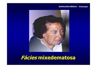 SEMIOLOGIA MÉDICA – Ectoscopia




Fácies mixedematosa
 