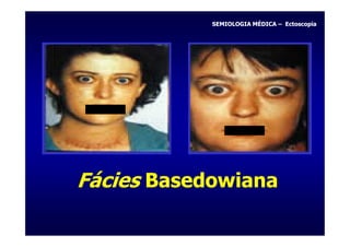 SEMIOLOGIA MÉDICA – Ectoscopia




Fácies Basedowiana
 