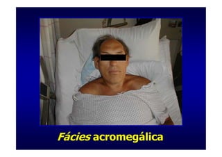 Fácies acromegálica
 