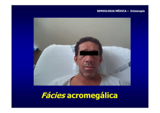 SEMIOLOGIA MÉDICA – Ectoscopia




Fácies acromegálica
 