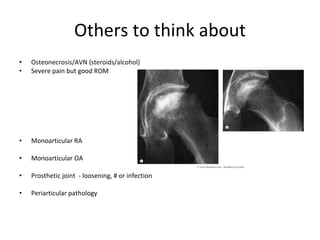 Others to think about Osteonecrosis/AVN (steroids/alcohol) Severe pain but good ROM  Monoarticular RA Monoarticular OA Prosthetic joint  - loosening, # or infection Periarticular pathology  