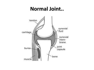 Normal Joint.. 
