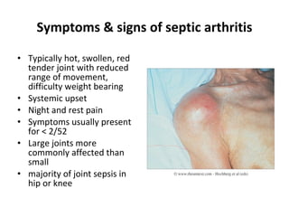 Symptoms & signs of septic arthritis Typically hot, swollen, red tender joint with reduced range of movement, difficulty weight bearing  Systemic upset Night and rest pain  Symptoms usually present for  <  2/52  Large joints more commonly affected than small majority of joint sepsis in hip or knee  