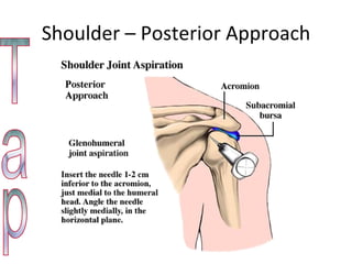 Shoulder – Posterior Approach Tap 