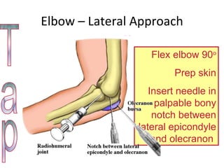 Elbow – Lateral Approach Tap Flex elbow 90 o Prep skin Insert needle in palpable bony notch between lateral epicondyle and olecranon  